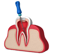 Root Canal Treatments